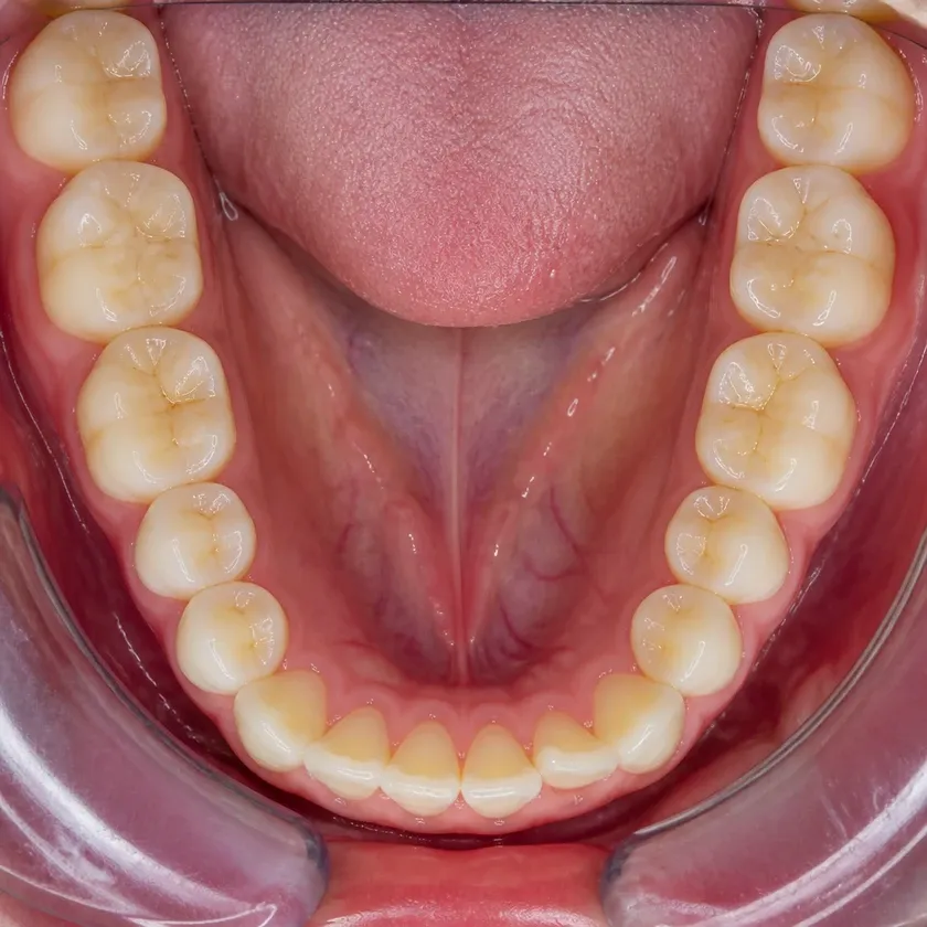 Periodontitis treatment — close-up clinical image of the result after treatment