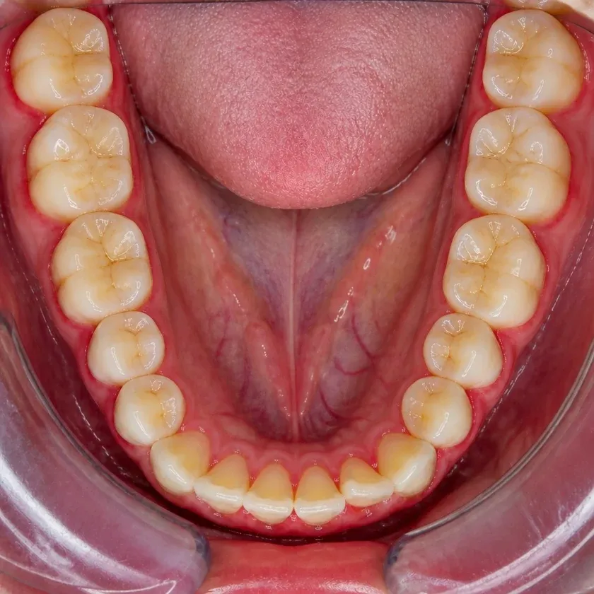 Periodontitis treatment — before-treatment condition on a clinical image
