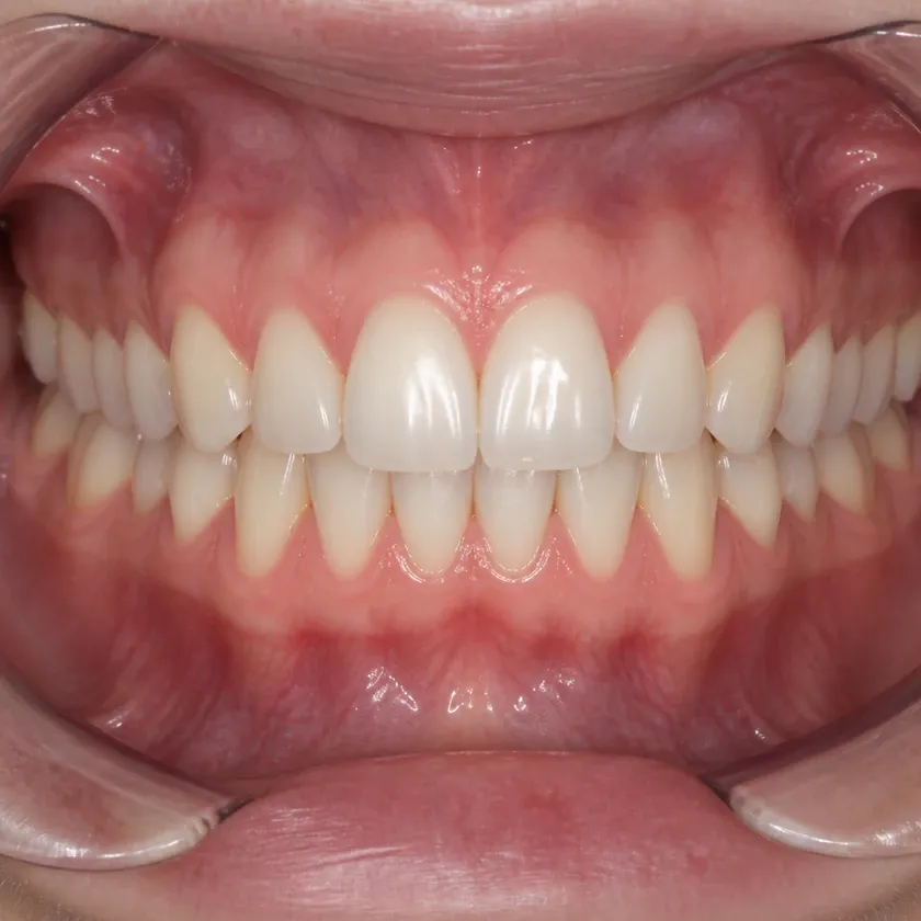 periodontitis treatment — close-up of the result after treatment on a clinical image