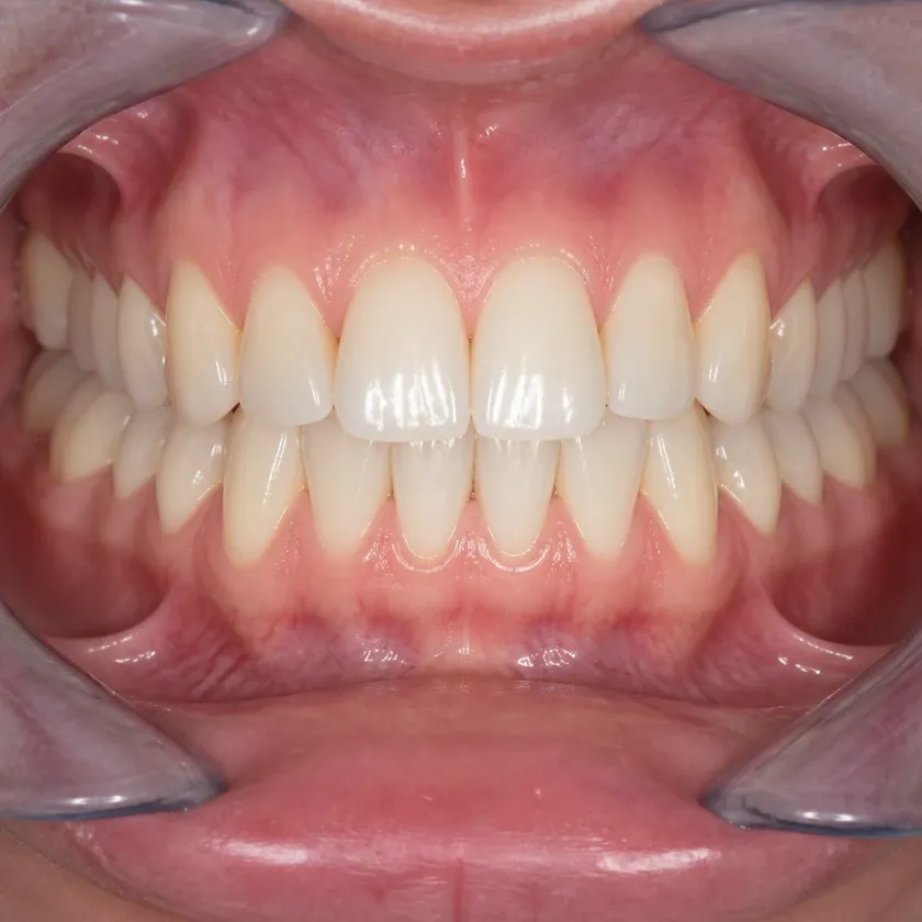 periodontitis treatment — close-up of the result after treatment on a clinical image