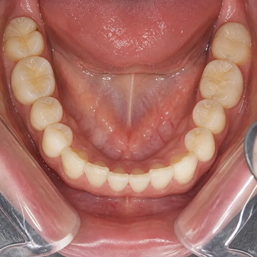 Periodontitis treatment — close-up clinical image of the result after treatment