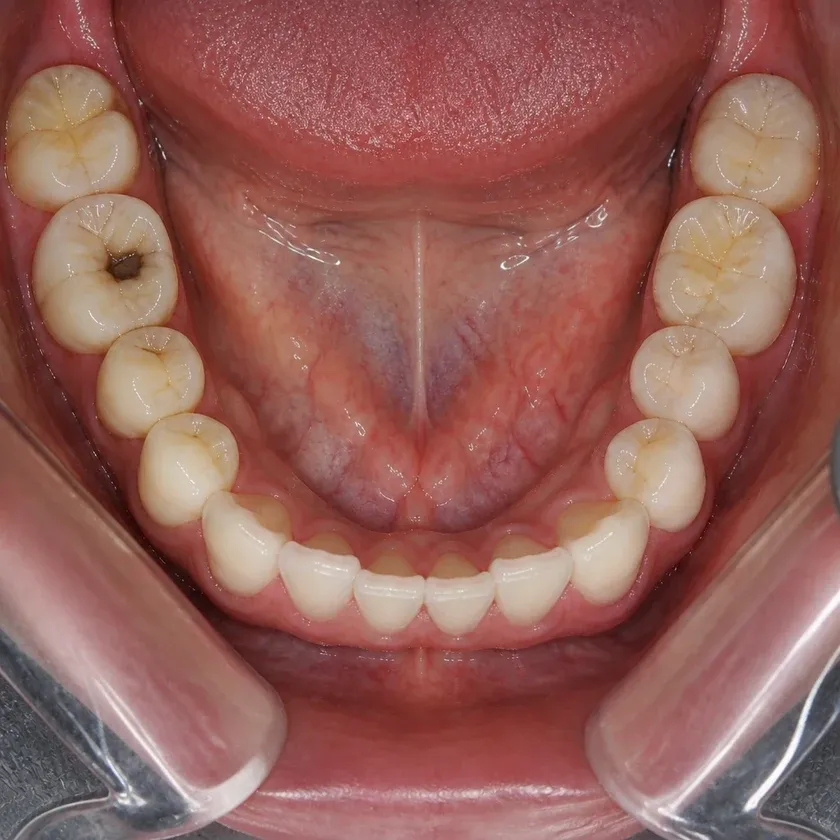 Treatment of periodontitis — pre-treatment condition on clinical image