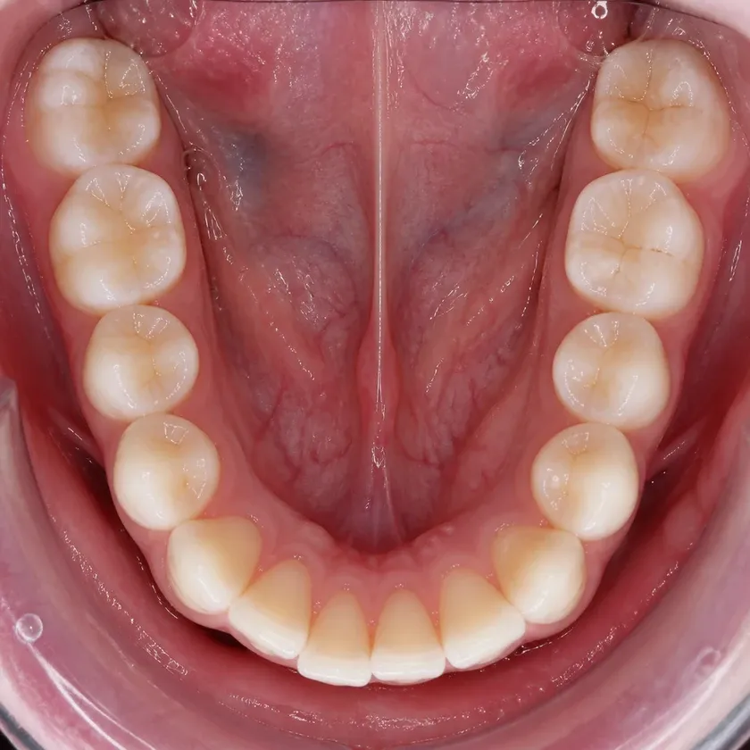 Periodontitis treatment — post-treatment result shown close-up on a clinical image