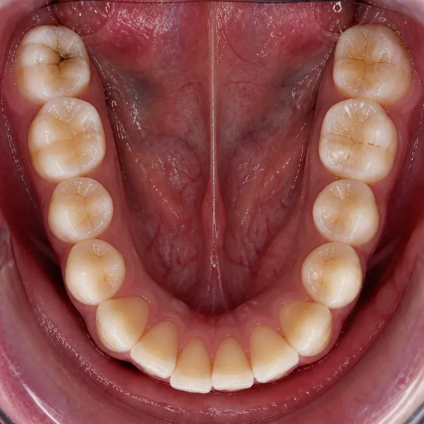 Treatment of periodontitis — pre-treatment condition on clinical image
