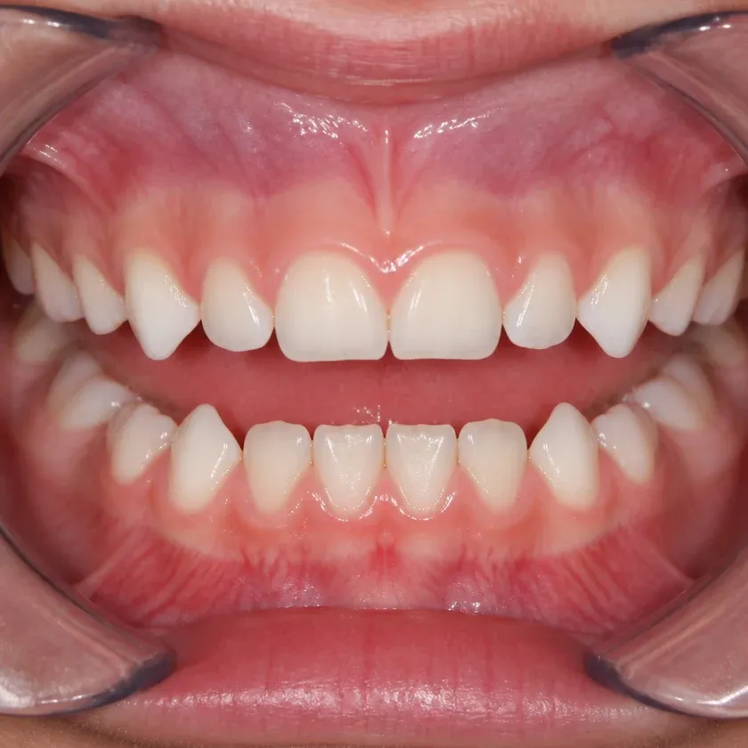 pediatric dental treatment — close-up of the result after treatment in a clinical photograph