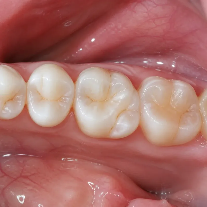 Laser dental treatment — close-up clinical photograph of the result after treatment