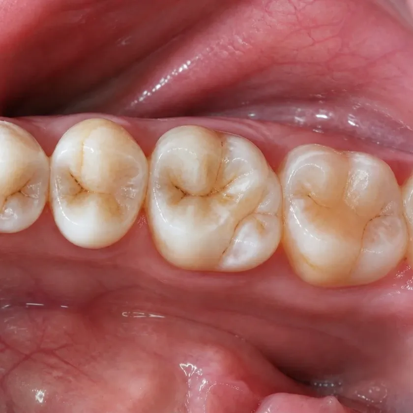 Laser dental treatment — before-treatment condition in a clinical image