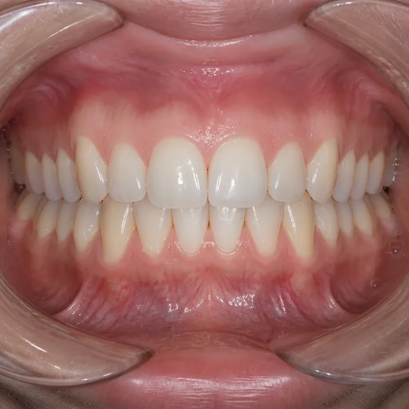 microscope-assisted dental treatment — close-up of the result after treatment in a clinical image