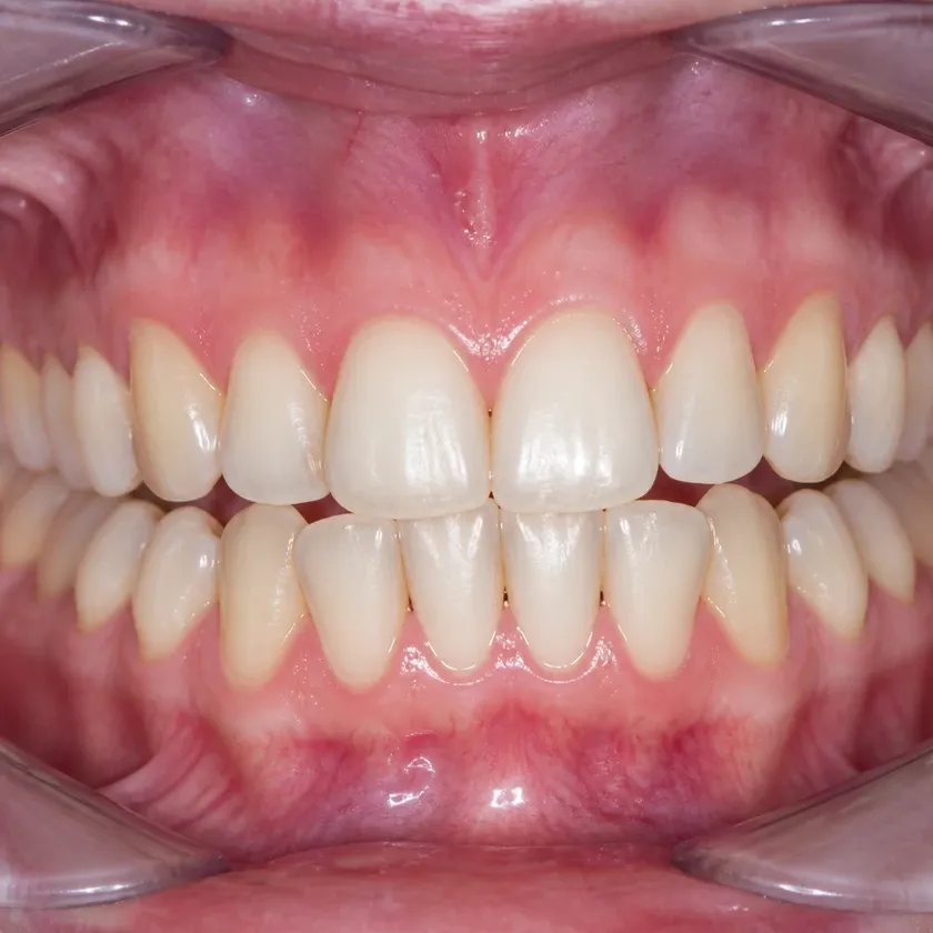 microscope-assisted dental treatment — close-up of the result after treatment in a clinical image