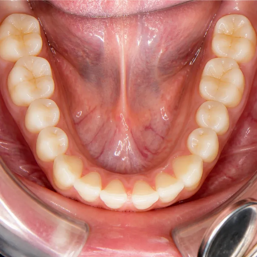 Microscope-assisted dental treatment — close-up clinical photo of the result after treatment