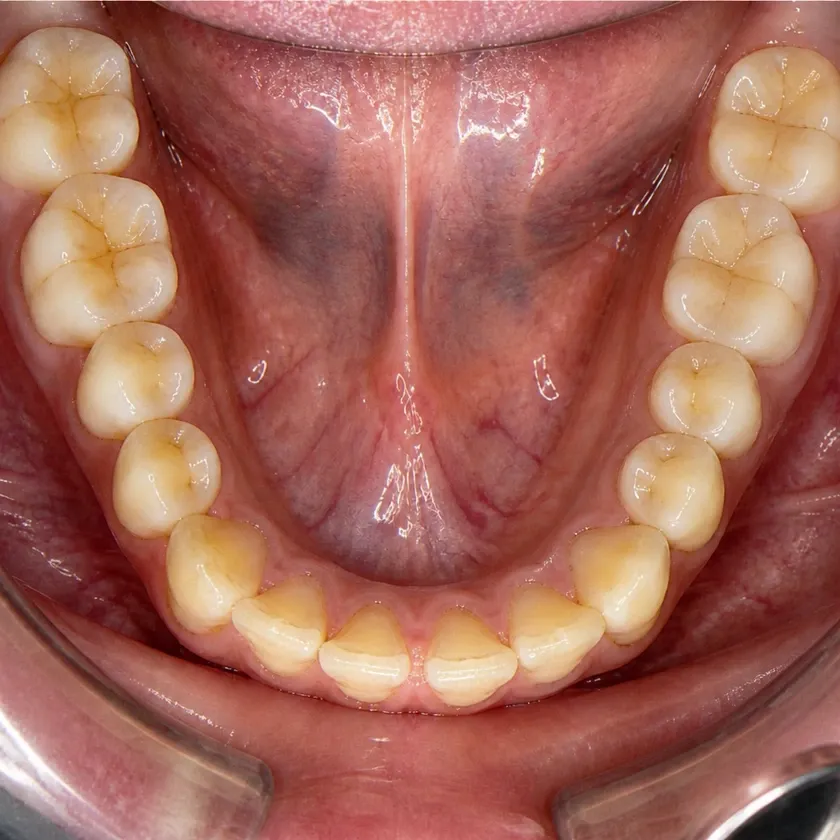 Microscope-assisted dental treatment — pre-treatment condition in a clinical photograph