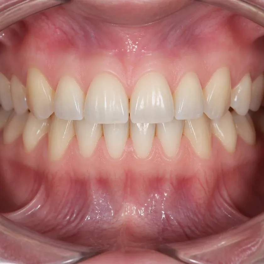 Dental treatment under a microscope — close-up clinical photo of the result after treatment