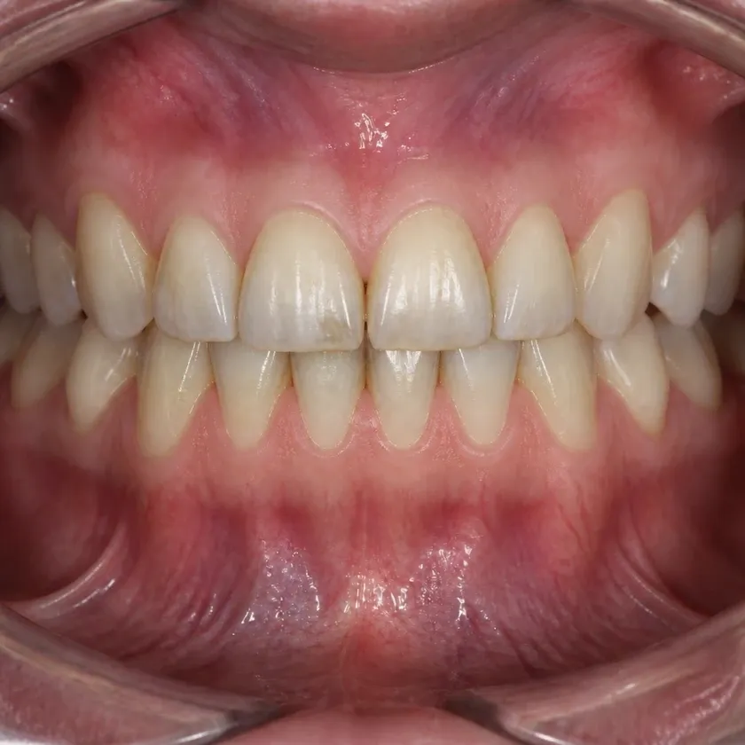 Microscope-assisted dental treatment — pre-treatment condition in a clinical photograph