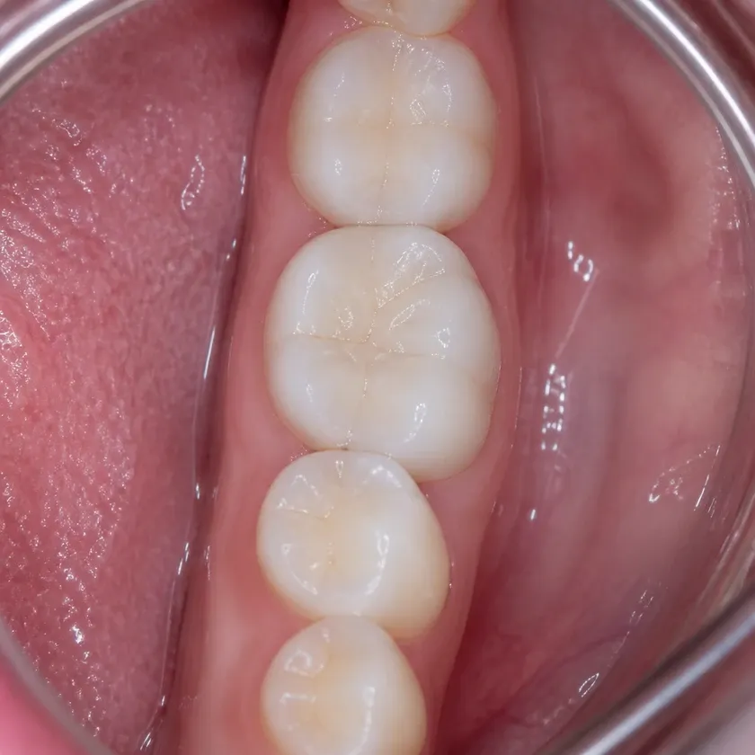 Dental treatment under general anesthesia — close-up clinical photo of the result after treatment