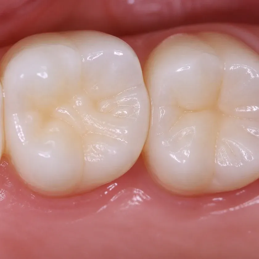 Dental treatment under sedation for children — close-up of the treatment result in a clinical photograph
