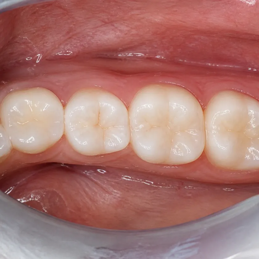 Dental treatment under sedation for children — close-up clinical photo of the result after treatment