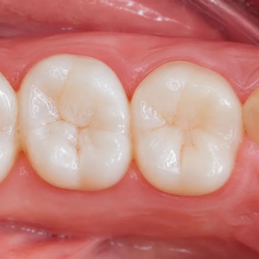 Pediatric dental treatment — close-up of the treatment result in a clinical image
