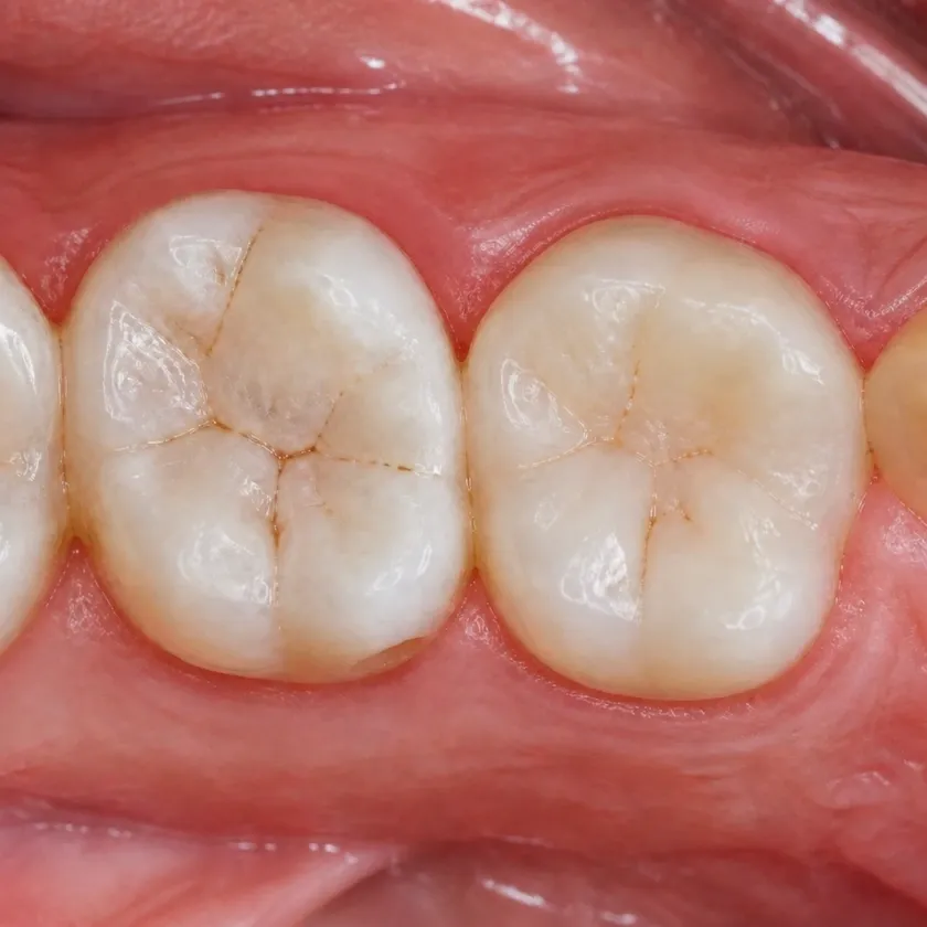 Dental treatment in children — pre-treatment condition on a clinical image