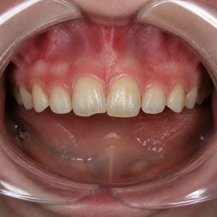 Dental treatment in children — pre-treatment condition on a clinical image
