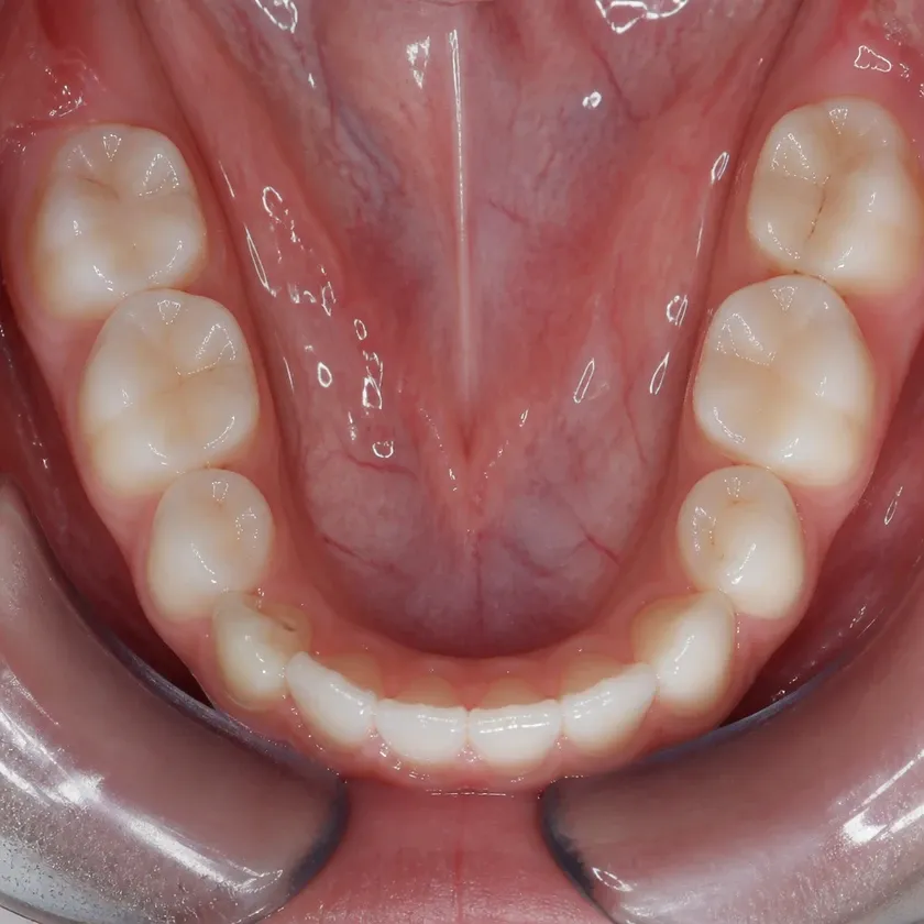 Children's dental treatment — close-up clinical image of the result after treatment