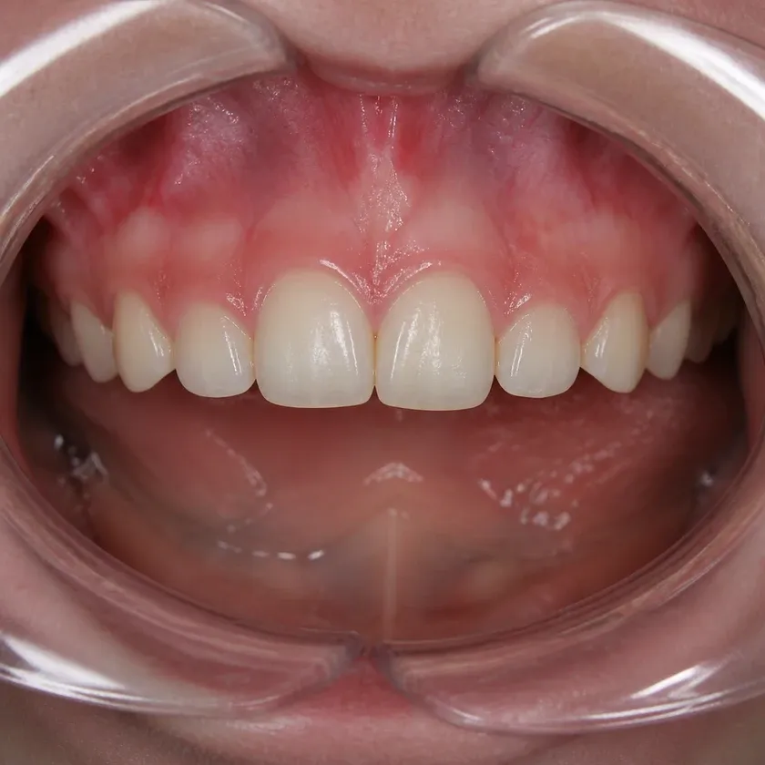 Children's dental treatment — close-up of the result after treatment in a clinical photograph