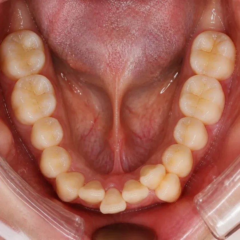 Lingual braces — pre-treatment condition in a clinical photograph