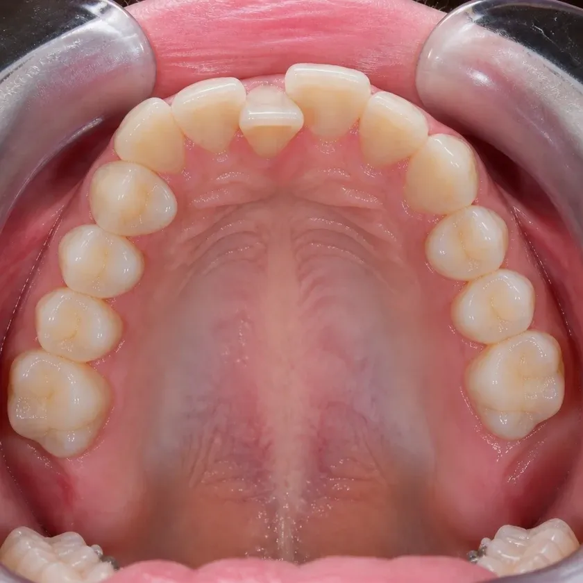 Lingual braces — pre-treatment condition in a clinical photograph