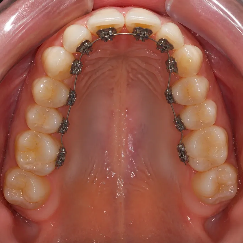 Lingual braces — close-up clinical photograph of the result after treatment