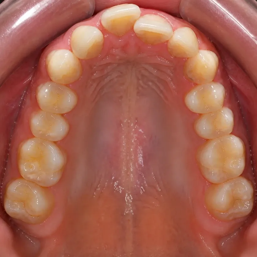 Lingual braces — pre-treatment condition in a clinical photograph