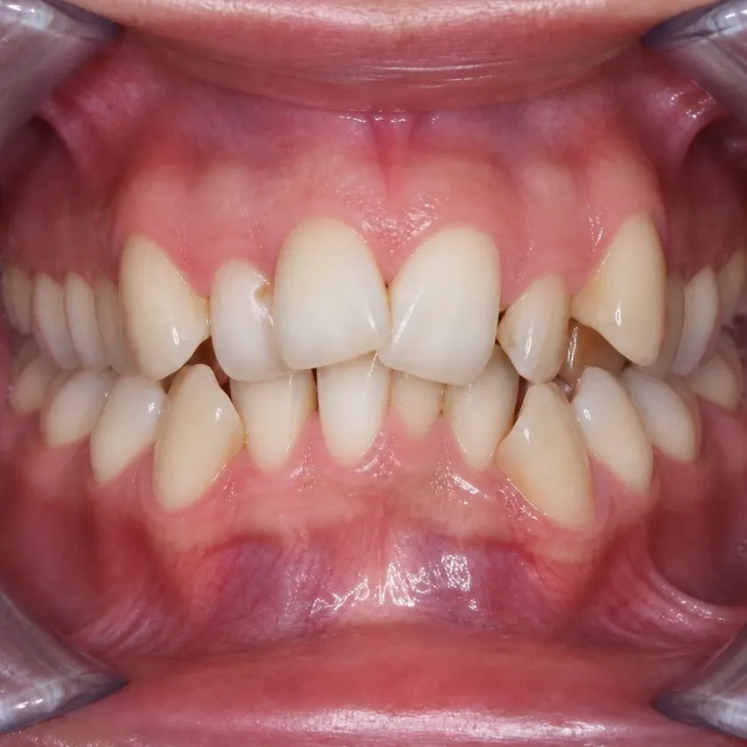 Lingual braces — pre-treatment condition in a clinical photograph