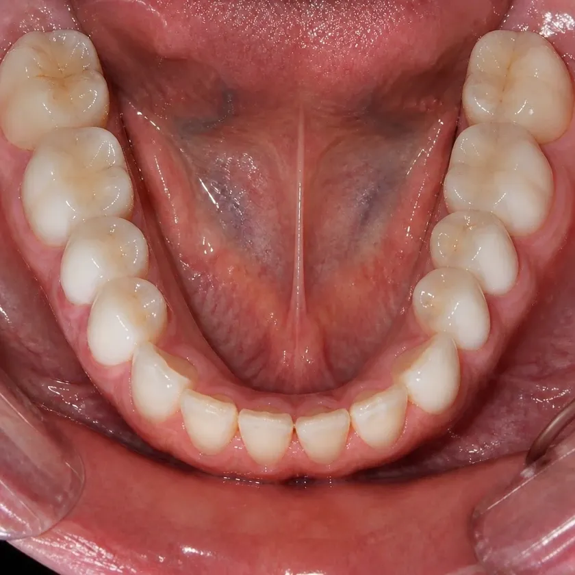 Lumineers — before-treatment condition in a clinical photograph