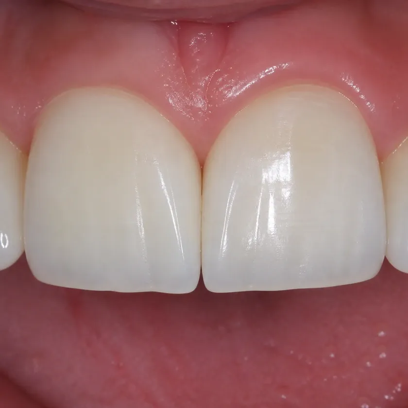 Lumineers — close-up of the treatment result in a clinical photograph