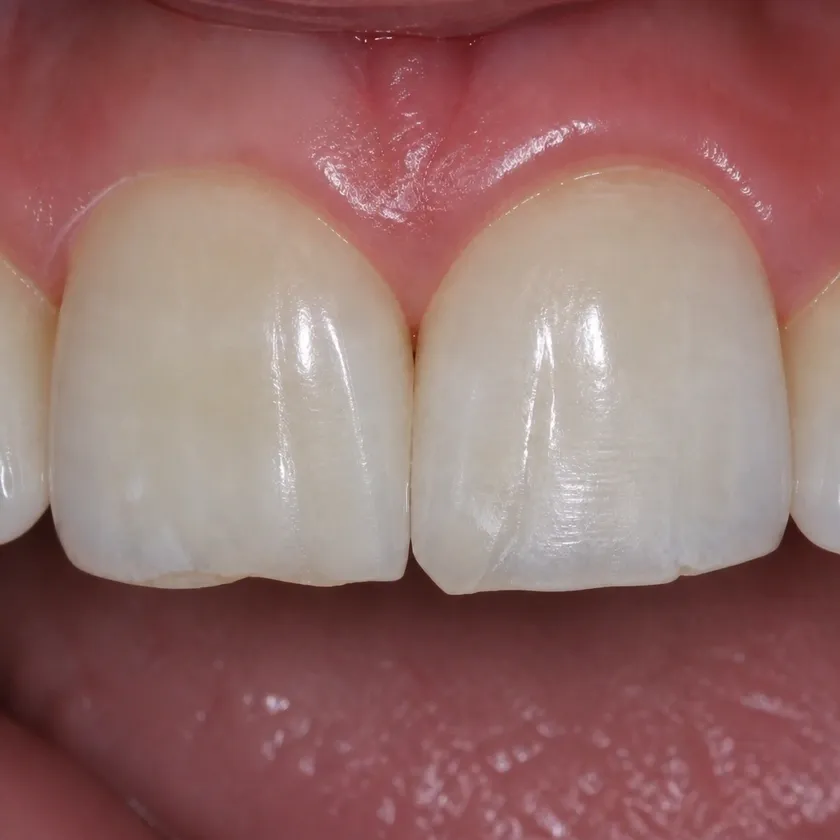 Lumineers — before-treatment condition in a clinical photograph