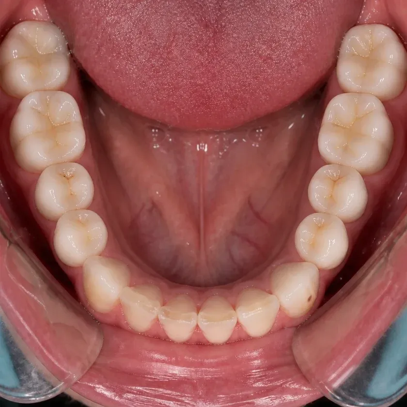 Lumineers — before-treatment condition in a clinical photograph