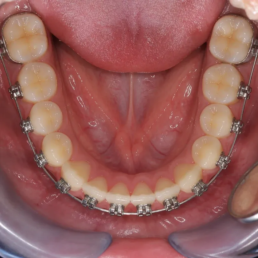 Metal braces — close-up clinical photo of the result after treatment