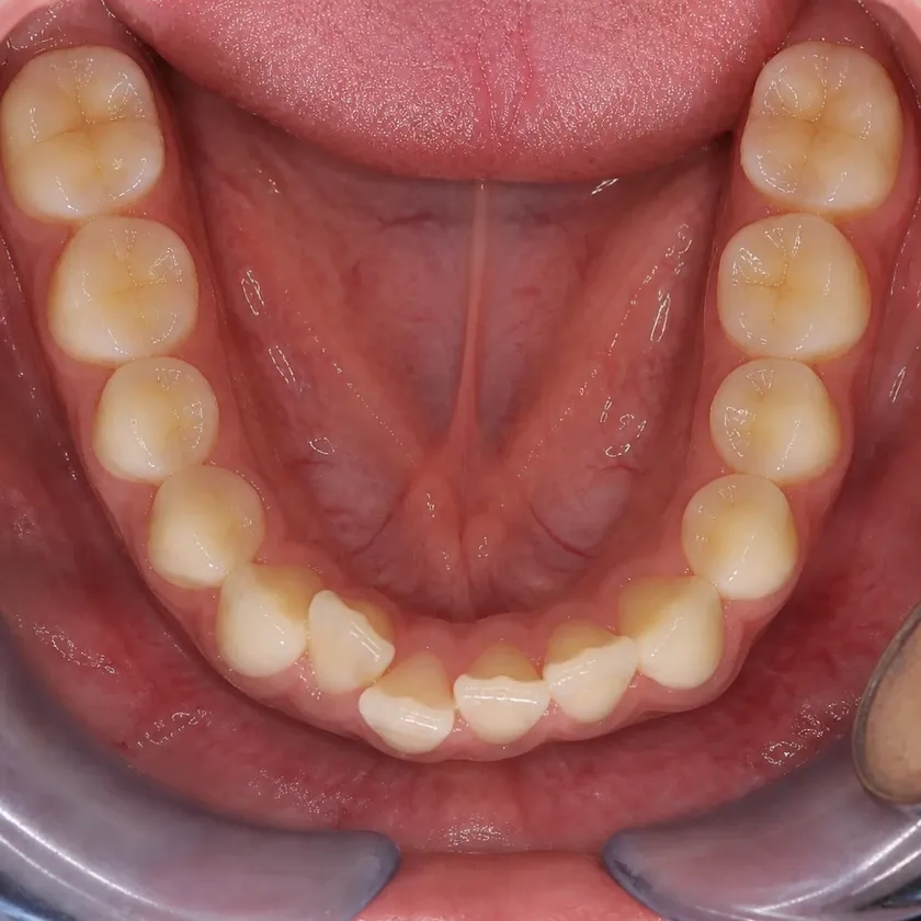 Metal braces — pre-treatment condition on a clinical image