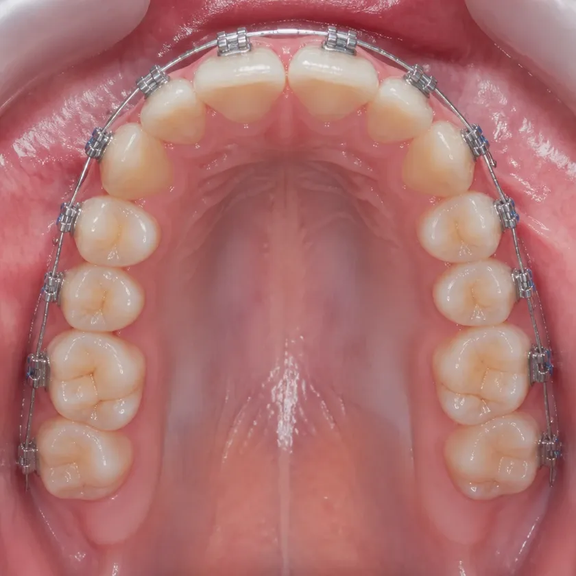 Metal braces — close-up clinical photo of the result after treatment