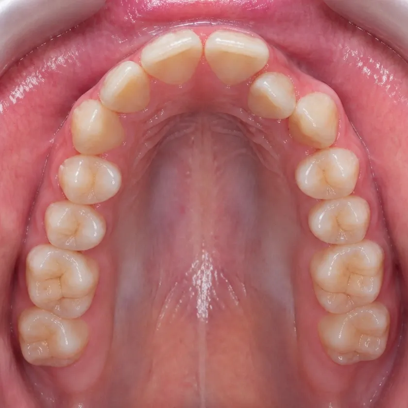 Metal braces — pre-treatment condition on a clinical image