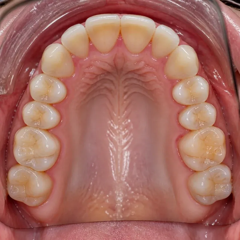 microprosthetics of teeth — result after treatment, close-up in a clinical photo