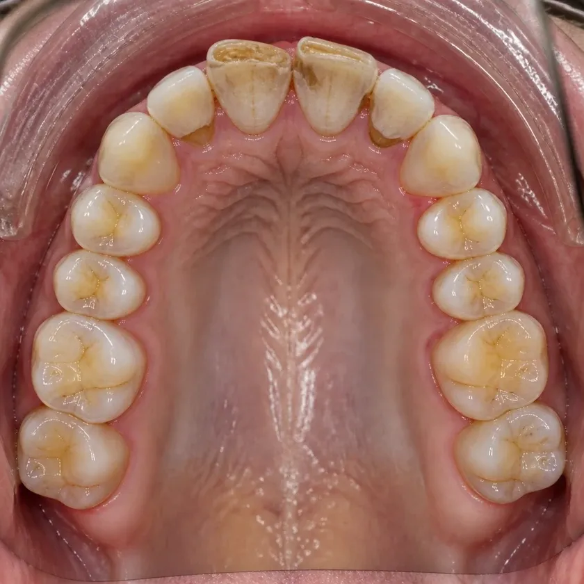 microprosthetics of teeth — pre-treatment condition on a clinical image