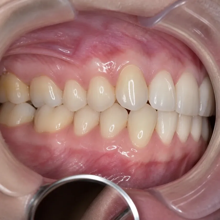 microprosthetics of teeth — result after treatment, close-up in a clinical photo