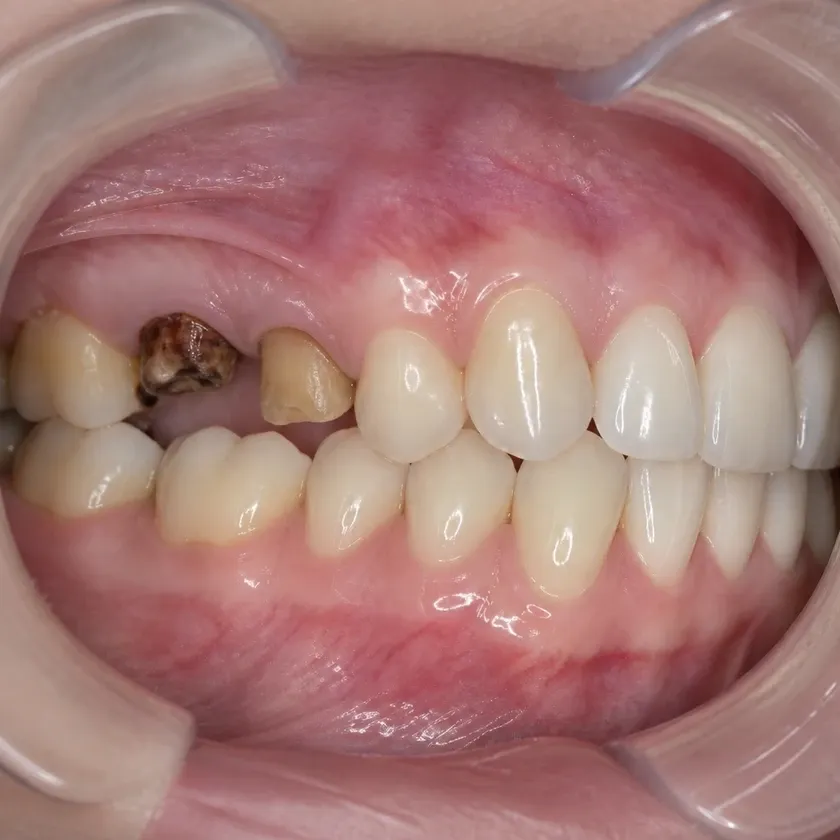 microprosthetics of teeth — pre-treatment condition on a clinical image