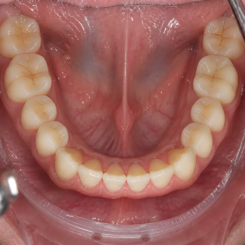 Microprosthetics of teeth — close-up clinical photo of the result after treatment