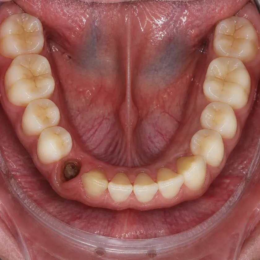 Microprosthetics of teeth — before treatment, clinical photograph
