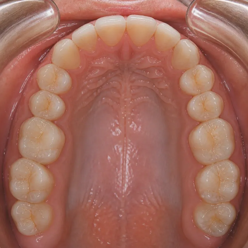 Microprosthetics of teeth — result after treatment, close-up on a clinical image
