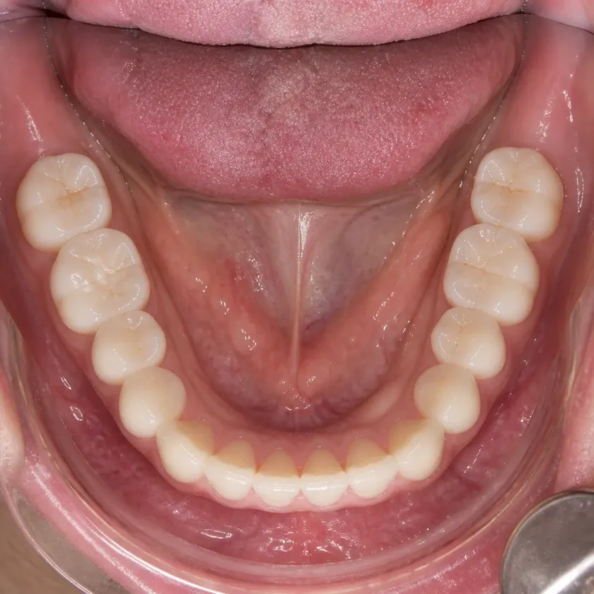 Immediate dental implantation — close-up clinical photograph of the result after treatment