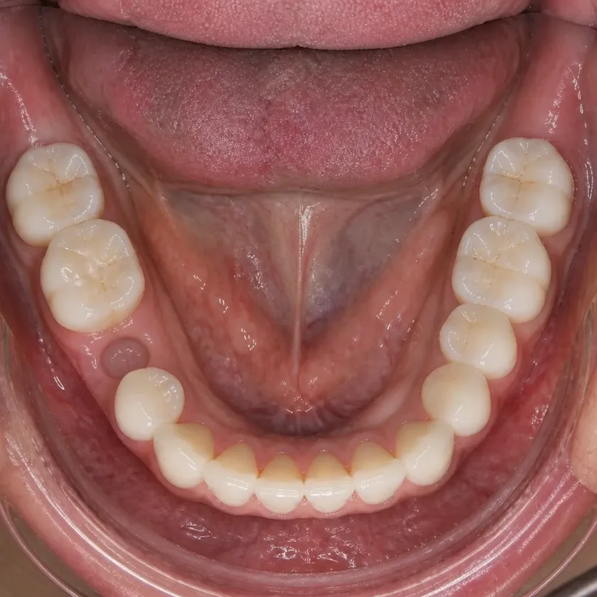 Immediate dental implant placement — pre-treatment clinical photograph