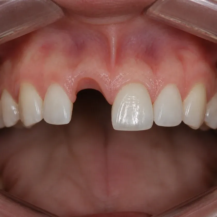 Immediate dental implant placement — pre-treatment clinical photograph