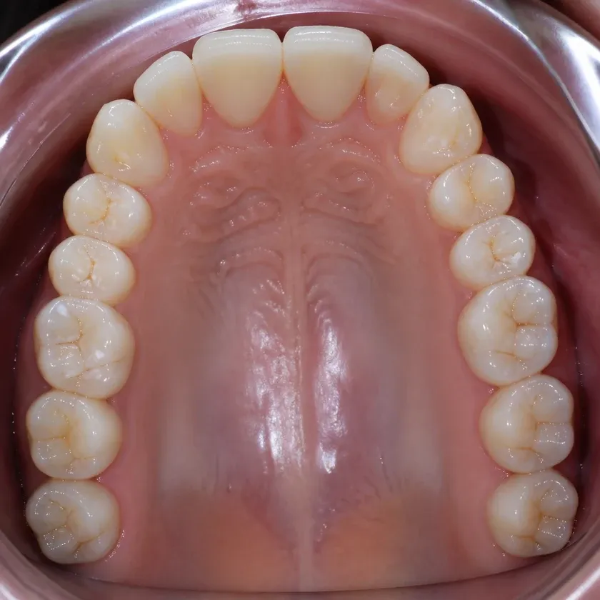 Immediate dental implantation — close-up of the treatment result on a clinical image