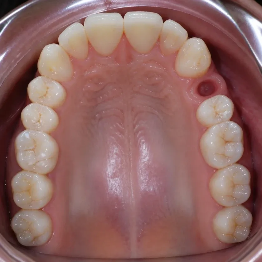 Immediate dental implant placement — pre-treatment clinical photograph